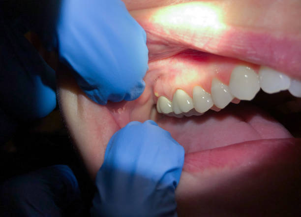 Best Dentist for Tooth Abscess  in Carolina Forest, SC